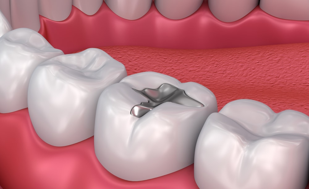 Mercury Free Fillings Offer a Better Alternative. Dentist in Beaverton, OR. Dr. Lennie D. Wong, DMD, FAGD, Dr. Maikhanh (MK) Tran, DMD. Beaverton TenderCare