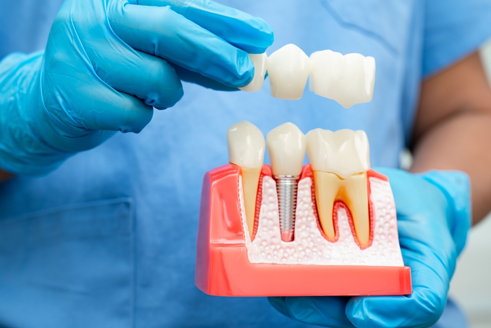 dental implants Beaverton